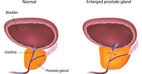 Transurethral resection of the prostate (TURP).